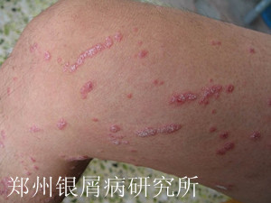 银屑病给青少年带来哪些危害