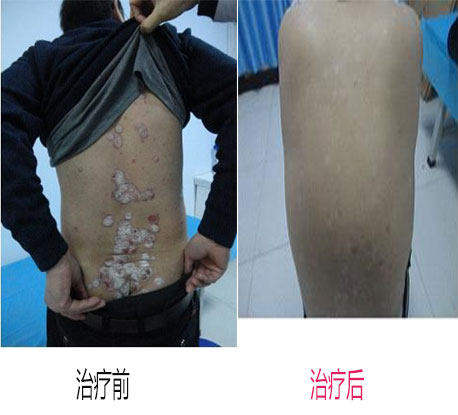 男性银屑治疗注意事项