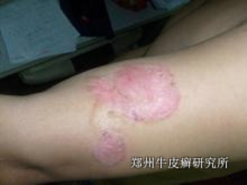 牛皮癣的具体病因有哪些