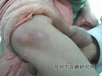 治疗早期牛皮癣有什么方法