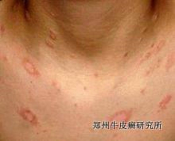 诱发牛皮癣病因有哪些