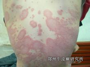 女性牛皮癣治疗有什么要注意的