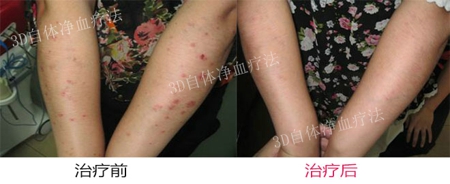 红皮型银屑病有哪些症状表现