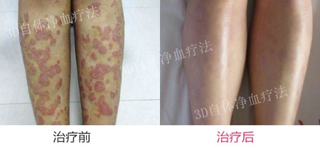 治疗银屑病时要注意哪些