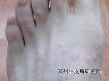 脚部牛皮癣怎么护理