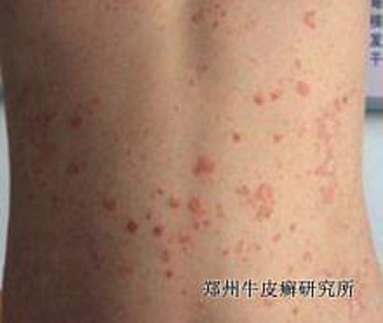 诱发牛皮癣的因素有哪些