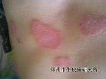 红皮型牛皮癣有哪些特点