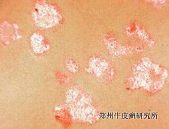 牛皮癣消退期要注意什么