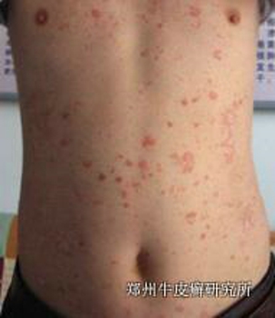 牛皮癣治疗时要注意什么事项