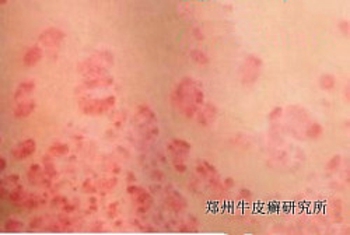 诱发牛皮癣的病因有哪些