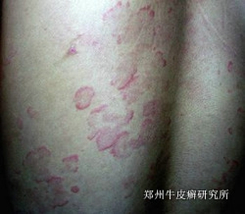 牛皮癣怎样才能治好