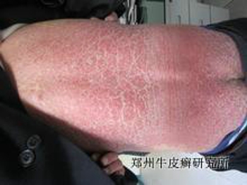 牛皮癣有哪些危害