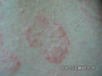 牛皮癣用药注意什么