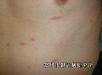 牛皮癣的护理怎么做