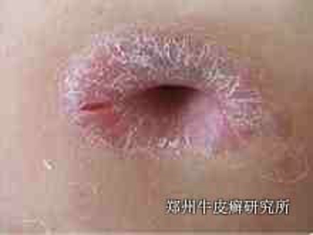 牛皮癣的治疗注意什么