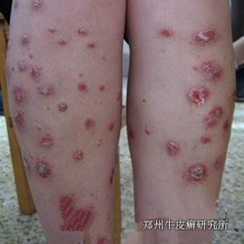 青少年牛皮癣怎么治