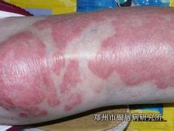 夏季牛皮癣患者怎么护理