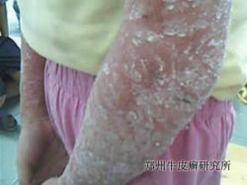 牛皮癣能治愈吗