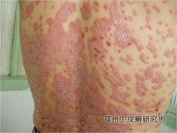 牛皮癣的初期症状