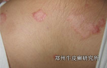 牛皮癣最好治疗方法