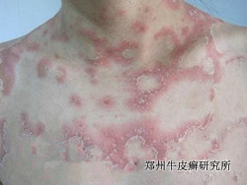 牛皮癣治疗的方法