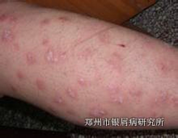 治疗牛皮癣