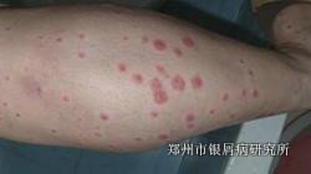 牛皮癣的治疗方法