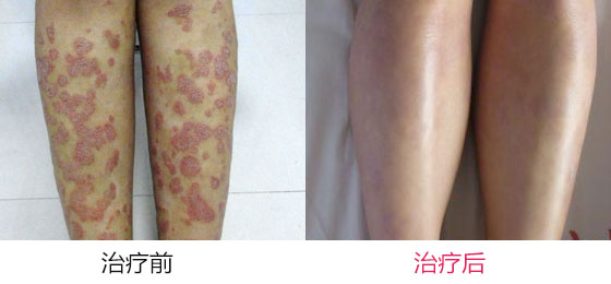 牛皮癣用什么药好