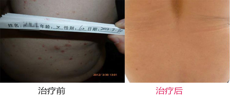 如何治疗牛皮癣