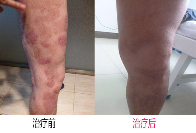 牛皮癣可以治愈吗