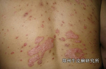 牛皮癣的原因