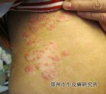 银屑病用药