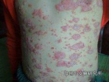 银屑病治疗费用