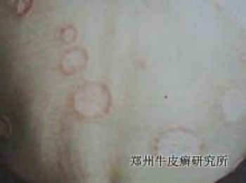 关节病型银屑病