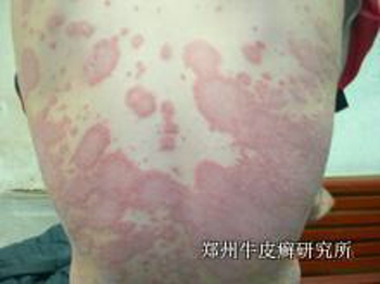 银屑病会传染吗