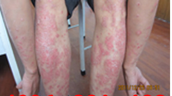 郑州银屑病研究所怎么样