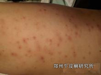 牛皮癣早期什么表现