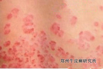 牛皮癣要怎样治疗呢