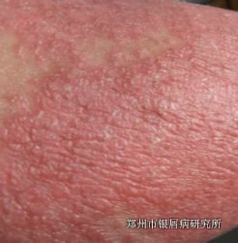 诊断牛皮癣有哪些依据