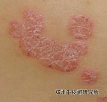郑州银屑病怎么治疗最好