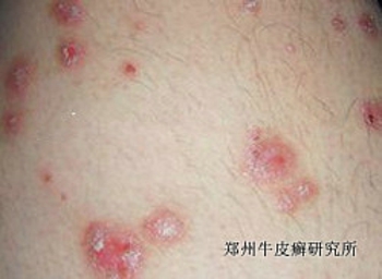 银屑病症状是什么